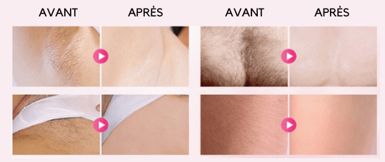 Epilateur laser à lumière pulsée intense