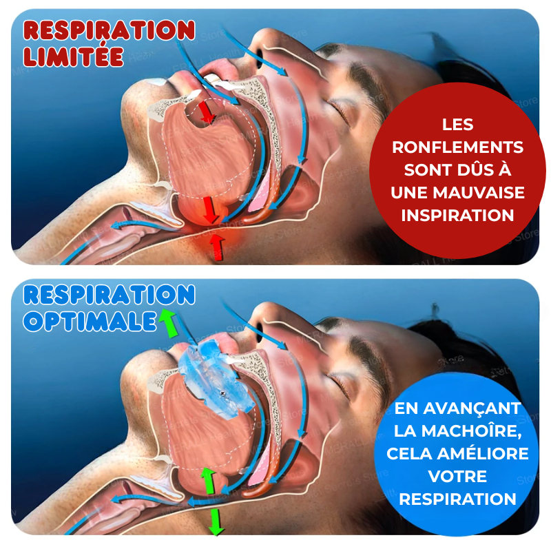 SILENCE SLEEP - Gouttière Anti-Ronflements & Anti-Apnée