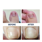 Patchs correcteur d'ongles incarnés